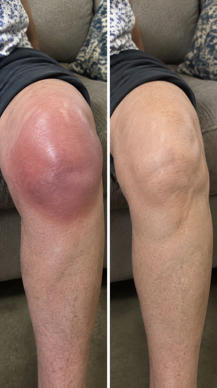 Illustrative before and after: red, sore-looking knee and calm knee